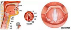 狐大医 | 声音嘶哑、饮水呛咳？可能是声带麻痹”
